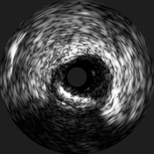 IVUS